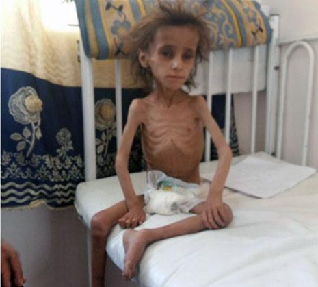نجت من القصف ولكن  قصة الطفلة اليمنية بتول الانسي